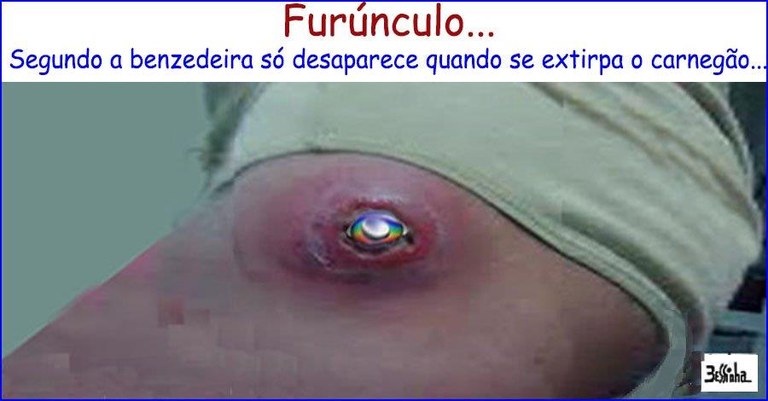 Furunculo.jpg Furunculo.jpg
